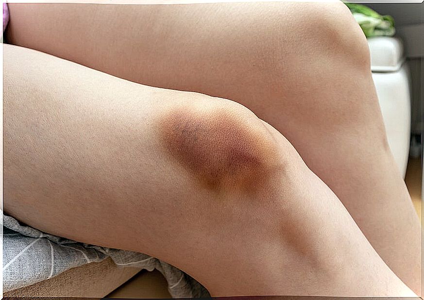 Bruise or bruise on the knee