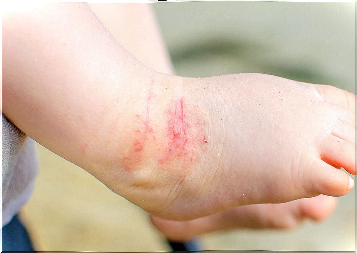 Atopic dermatitis is usually a lifelong condition, studies say