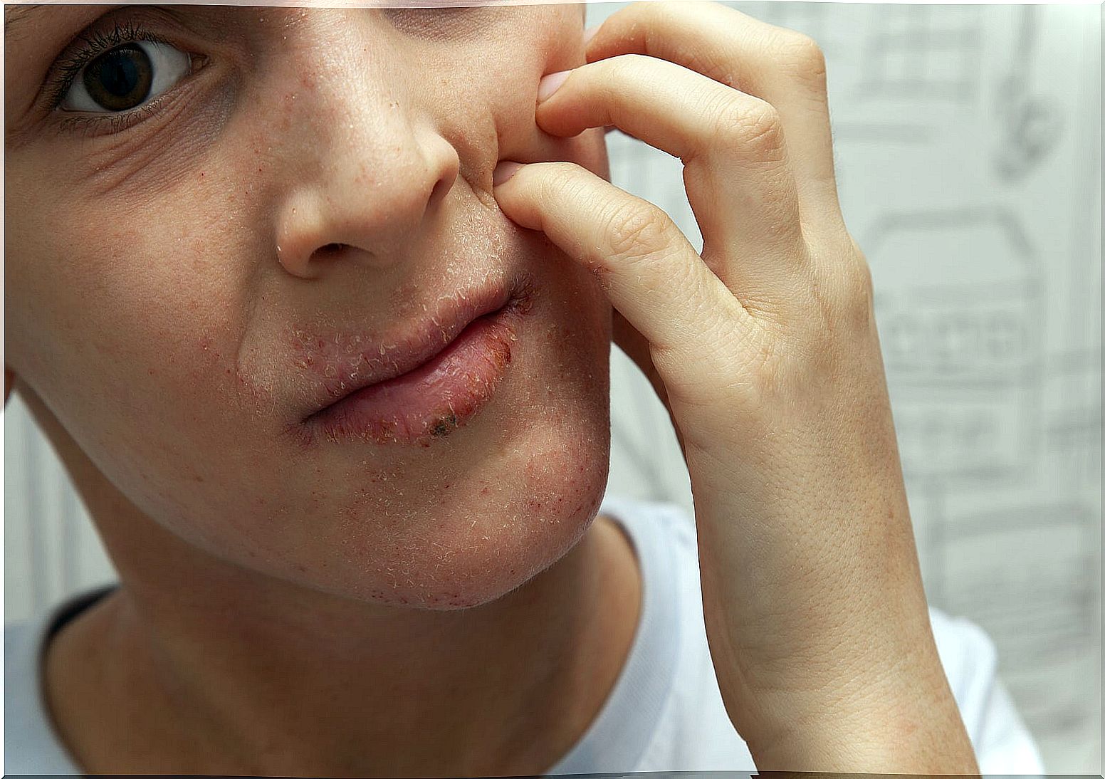 Atopic dermatitis on the face.