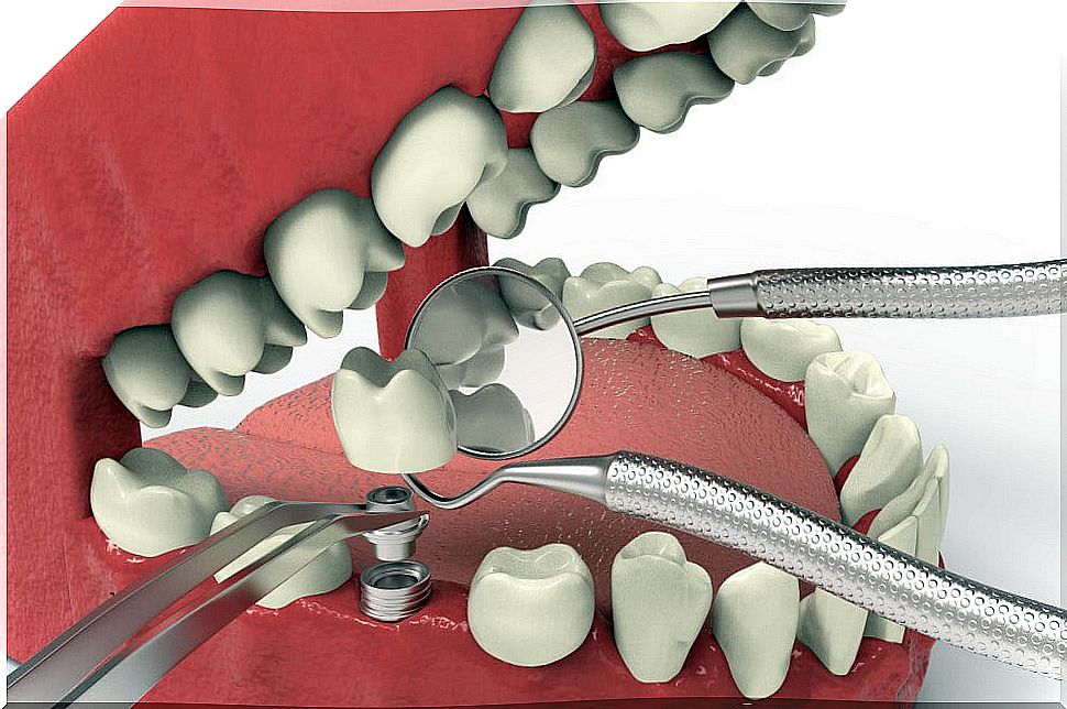 Digital recreation of a dental implant.  Treatment for dental agenesis.