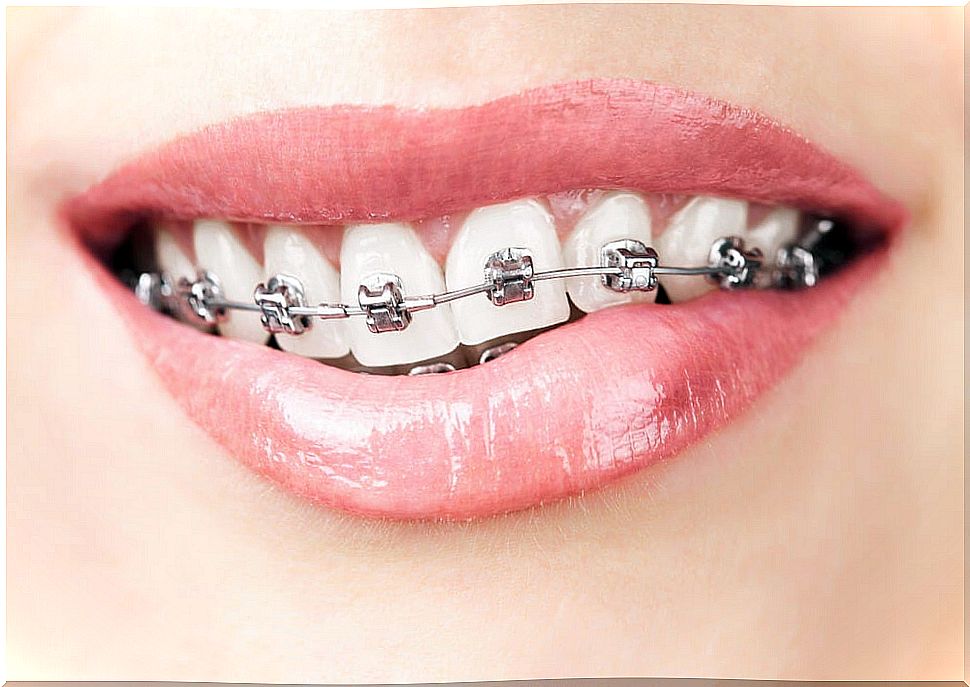 Teeth with orthodontics.  Treatment for dental agenesis.