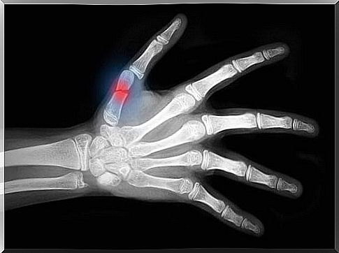 How to speed up the healing of a bone fracture