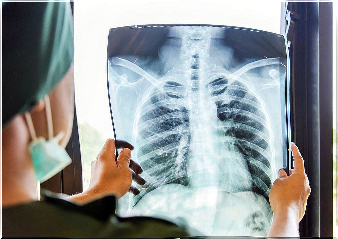 Tuberculosis diagnosis with radiography.