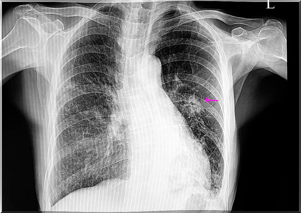 Pulmonary nodule, what does it mean?