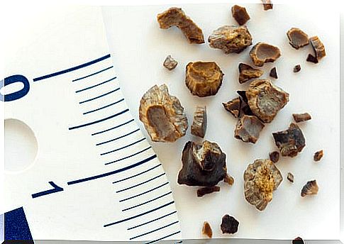 Kidney stones