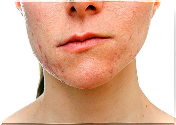 Chin acne