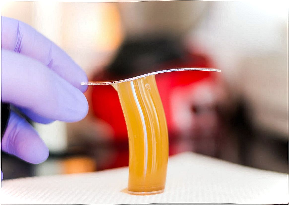 Stool test for strongyloidiasis.